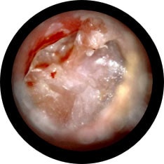 Cholesteatoma image taken with hearScope example 2